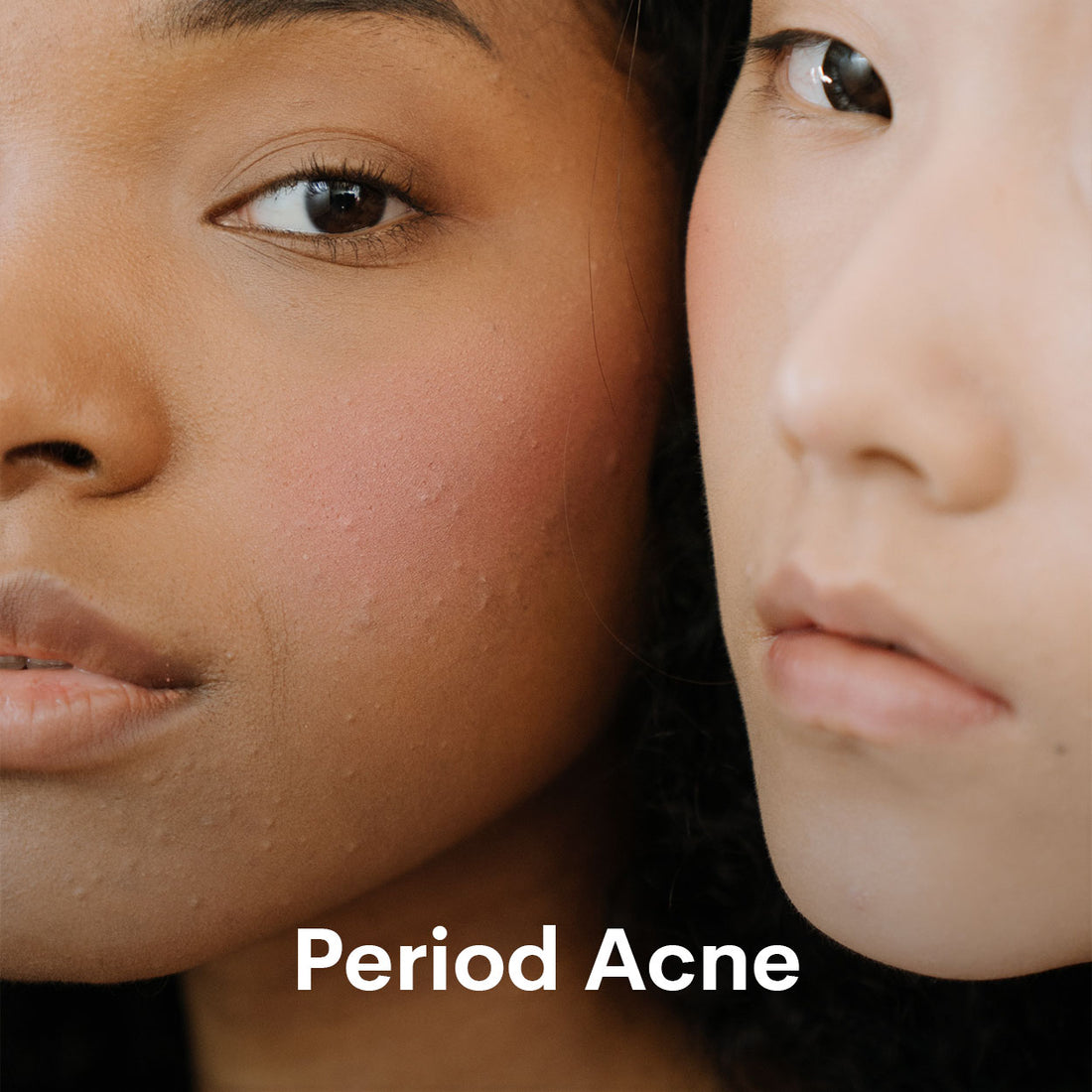 Period Acne | Period Breakouts_WUKA.co.uk