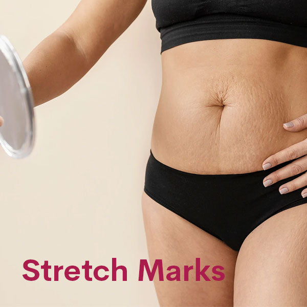 Stretch Marks